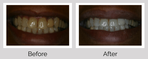 Veneers Before and After - Crown Point Dental