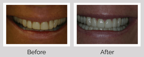 Veneers Before and After - Crown Point Dental