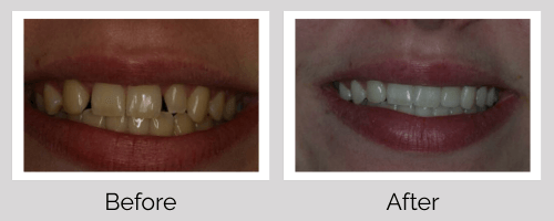 Veneers & Whitening Before and After - Crown Point Dental