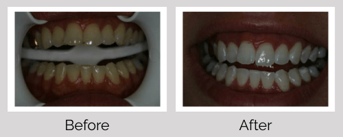 Whitening Before and After - Crown Point Dental