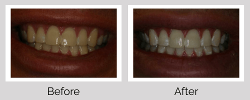 Whitening Before and After - Crown Point Dental