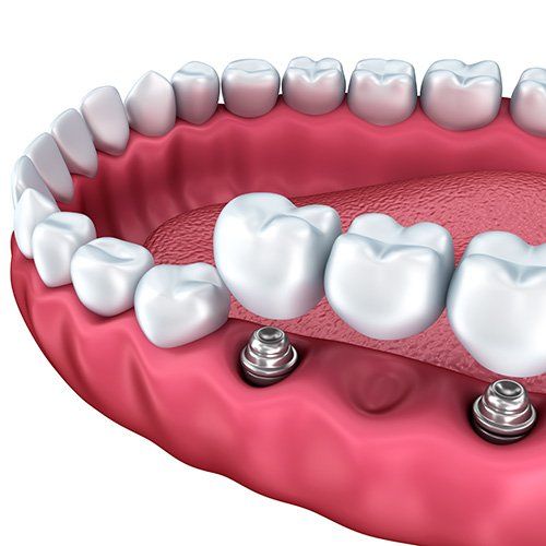 Dental Implants - Crown Point Dental
