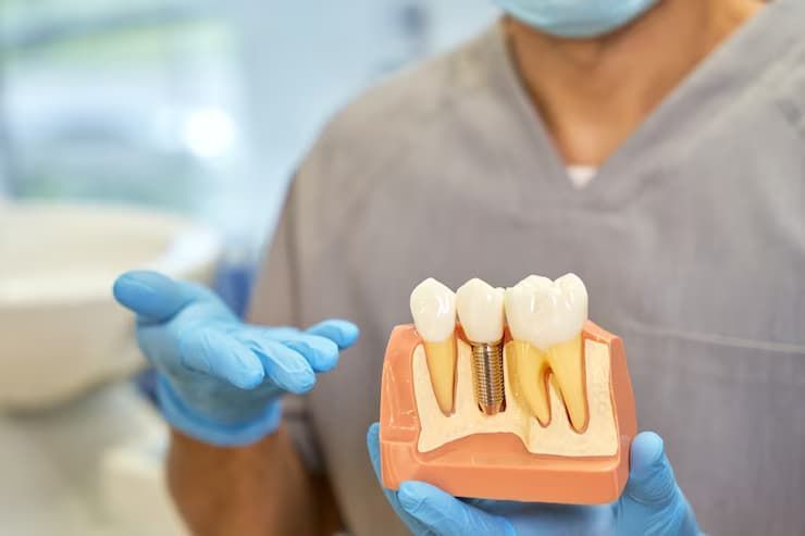 tooth implant in Columbus, Ohio