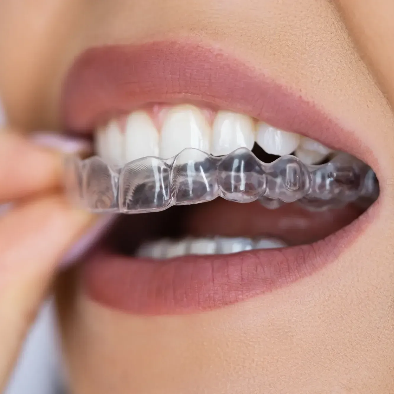 Closeup of person putting invisalign aligner on top teeth