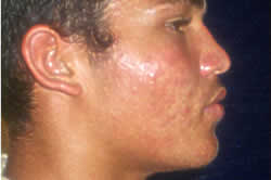 MediTouch® Stage 1 Acne