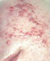 MediTouch® Stage 3 Acne