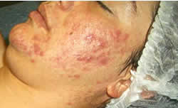 MediTouch® Stage 4 Acne