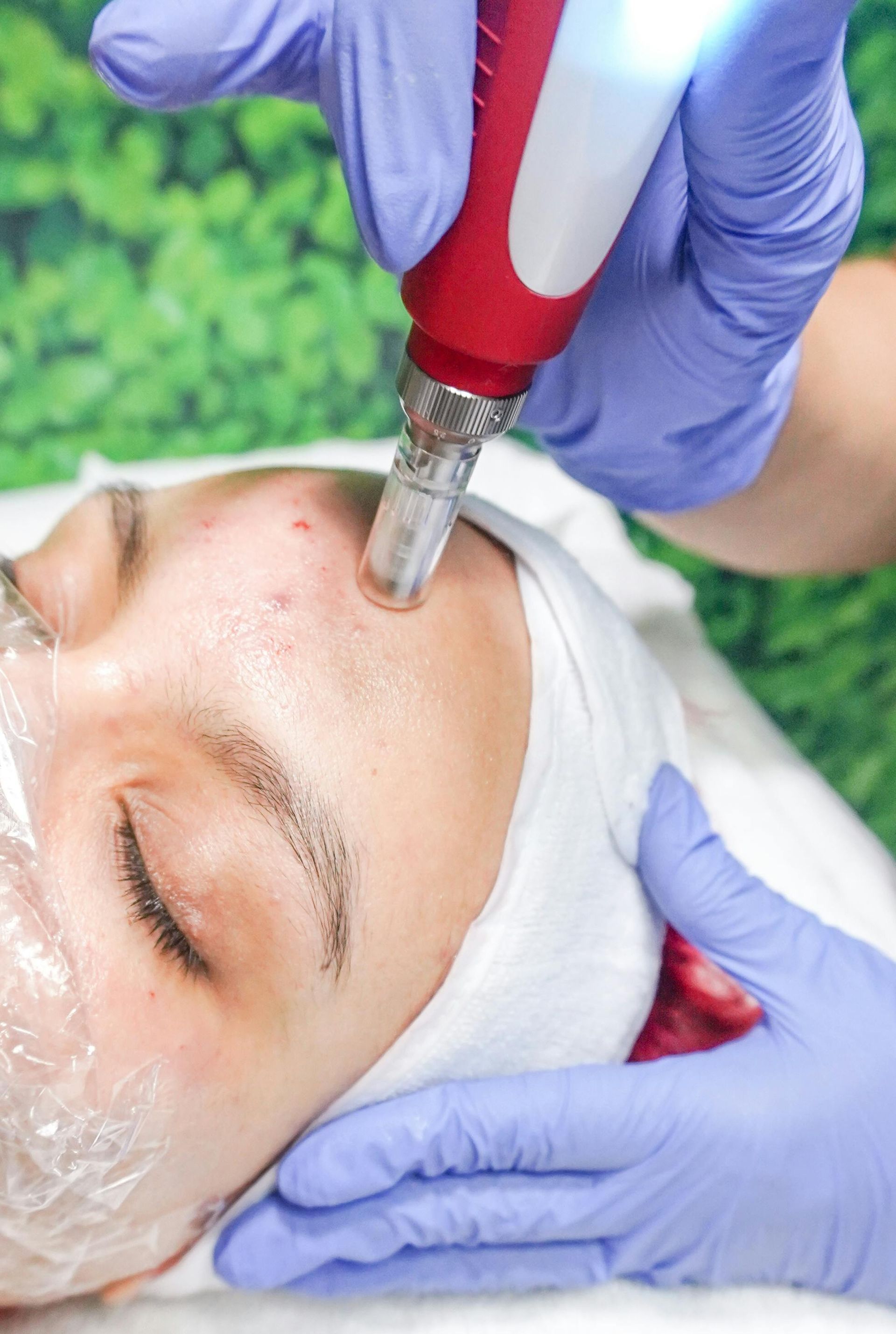 Person receiving microneedling treatment on their face with a medical device. Blue gloves, white cloth, green background.