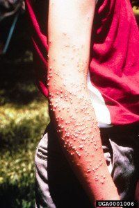 fire ants stings on man 