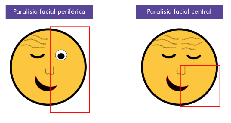 Paralisia Facial Conhe a Mais Sobre Essa Patologia