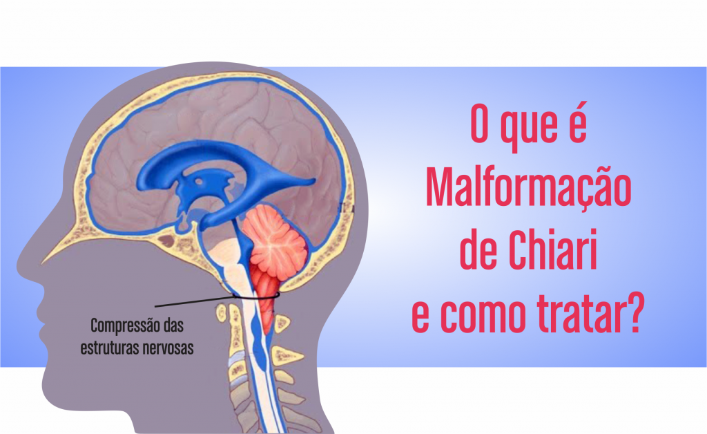 O que é Malformação de Chiari e como tratar?