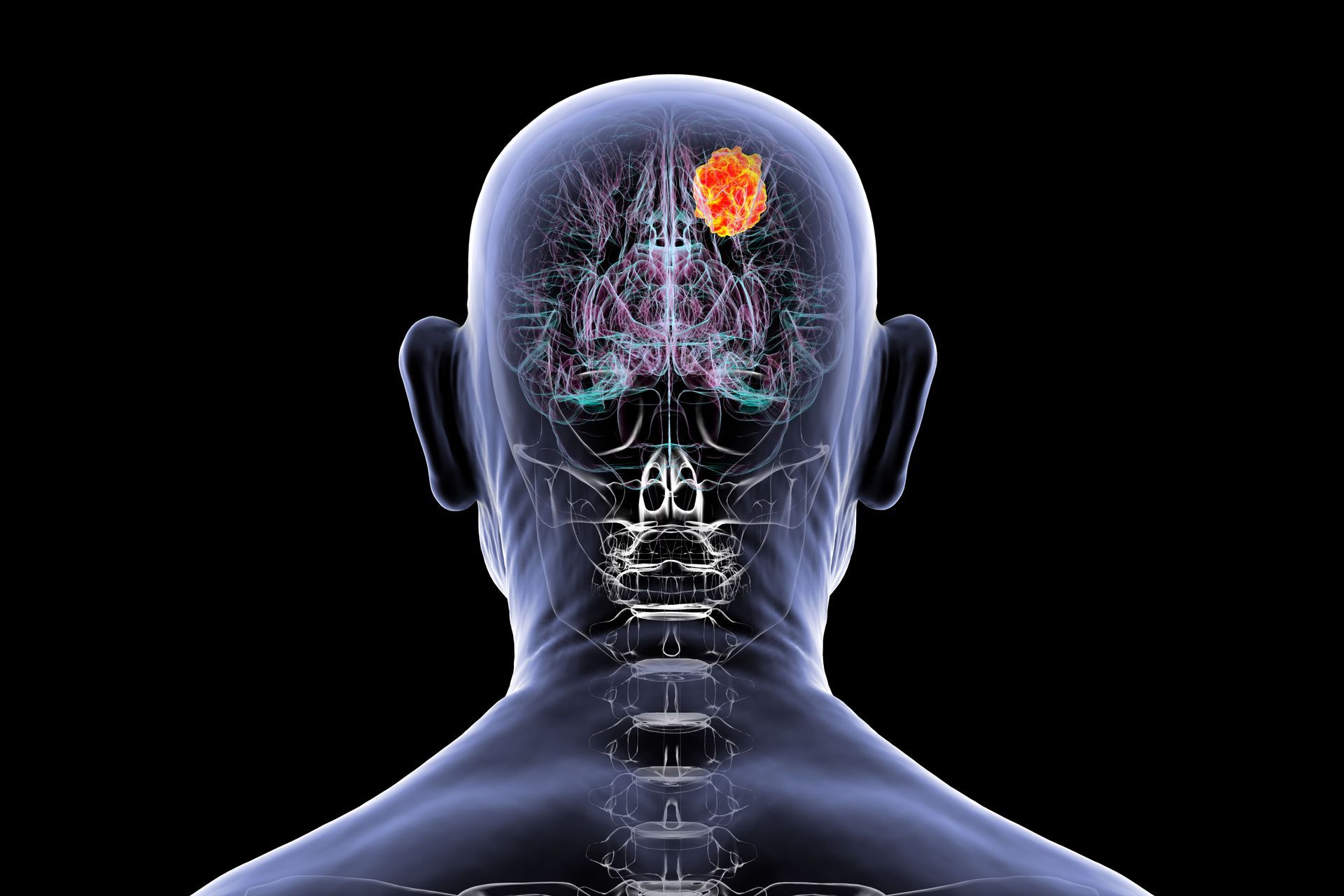 especialista em meningioma