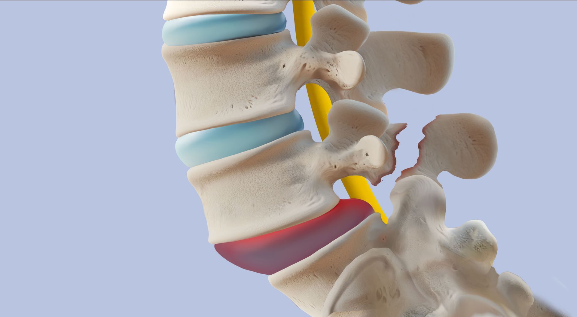 espondilolistese ístmica