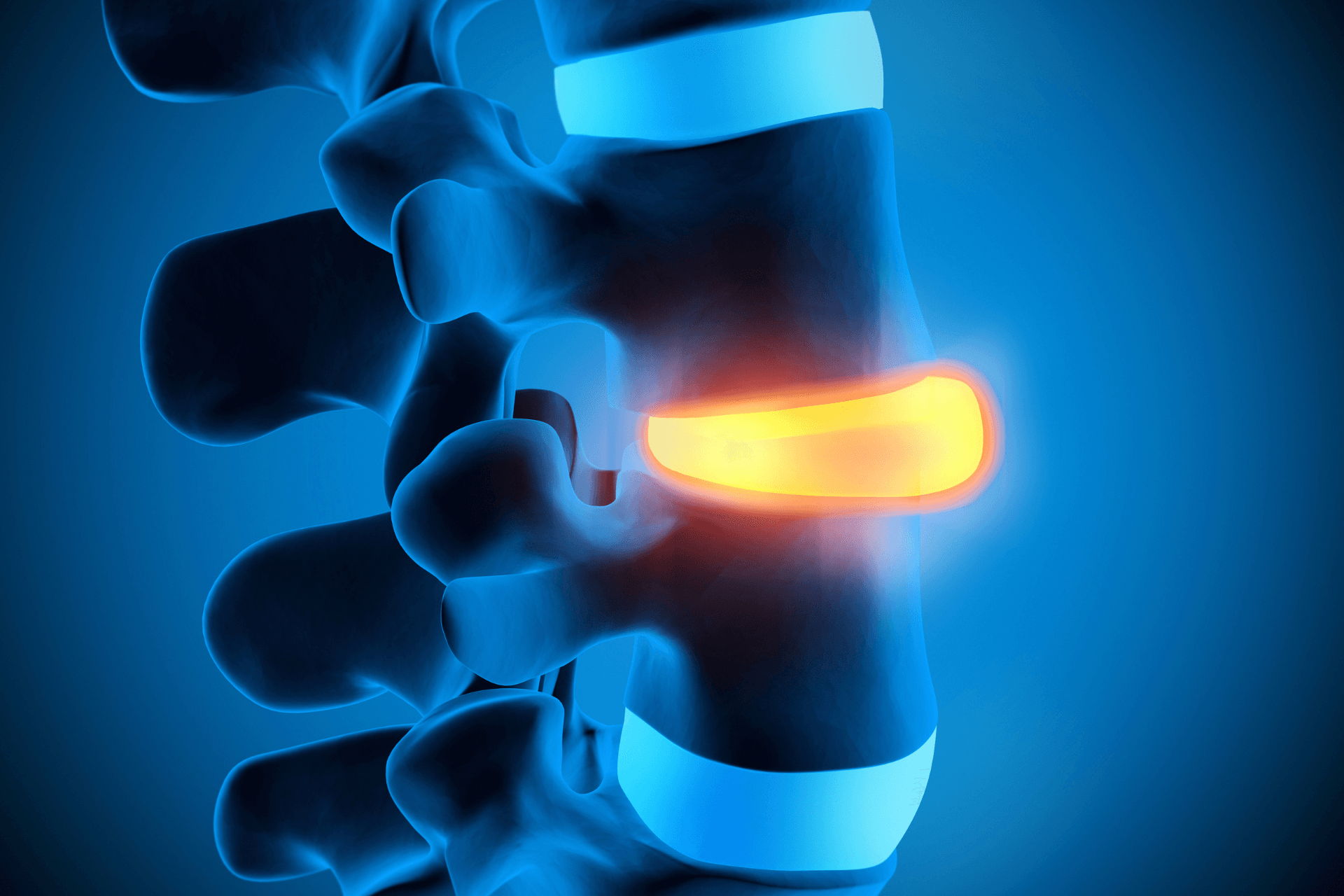 Conheça os diferentes tipos de hérnia de disco