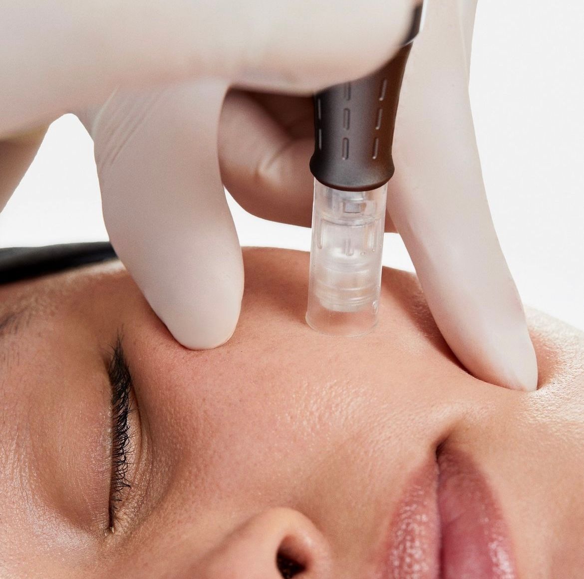 A woman is getting a cosmetic treatment on her face