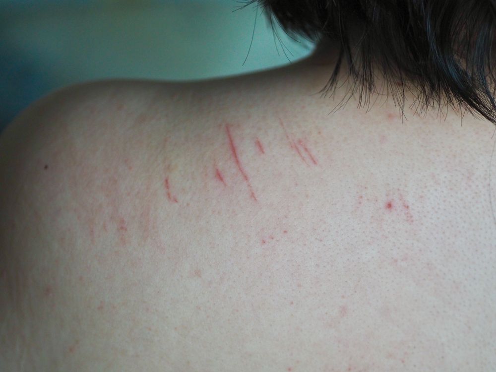 Close-up of human skin on a shoulder showing several thin, red linear scratches and scattered small spots.