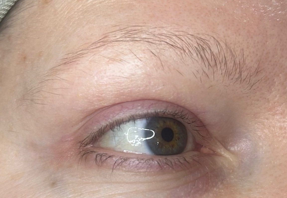 Close-up of a human eye with a cloudy white patch over the pupil