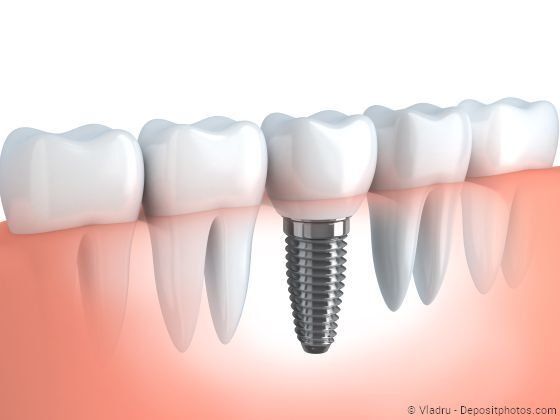 Implantate sitzen sicher und fest und fühlen sich an wie eigene Zähne.