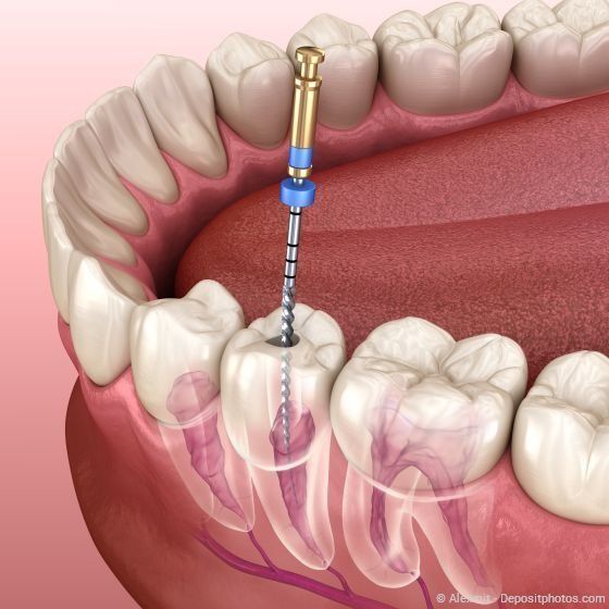 Gründlich wird das infizierte Gewebe entfernt, die Wurzelkanäle gereinigt, gespült und desinfiziert bevor der Zahn wieder verschlossen wird.