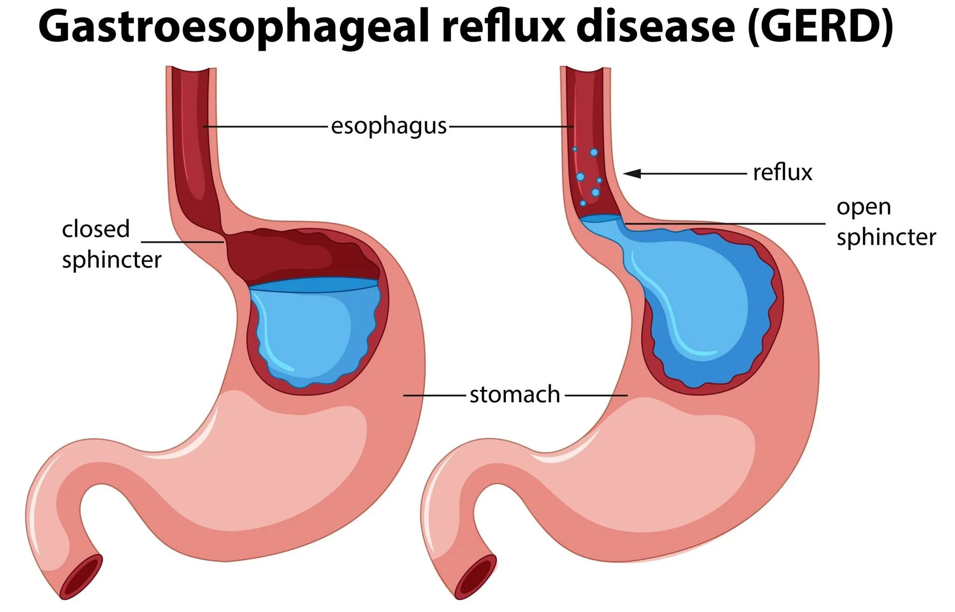 Gastrosophageal Reflux Disease Illustration