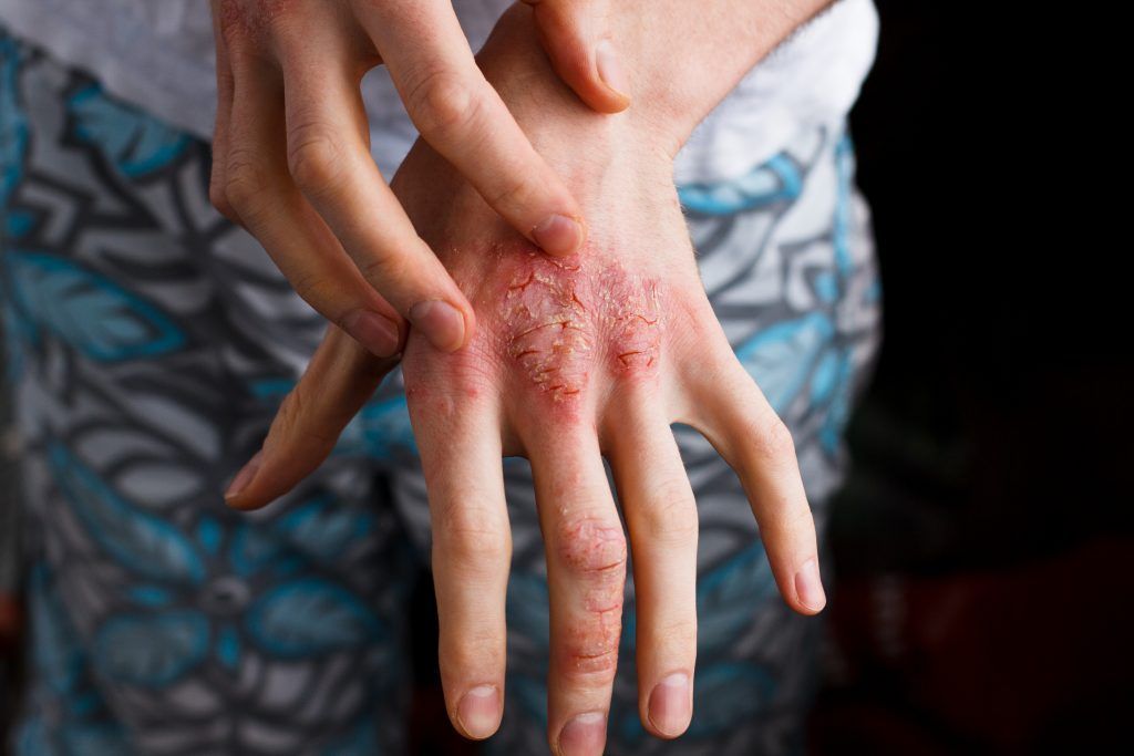 Psoriasi on the Hand