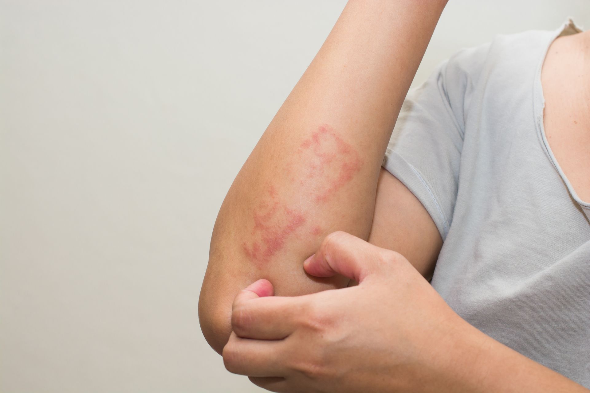 Scratching the Itchy Psoriasis