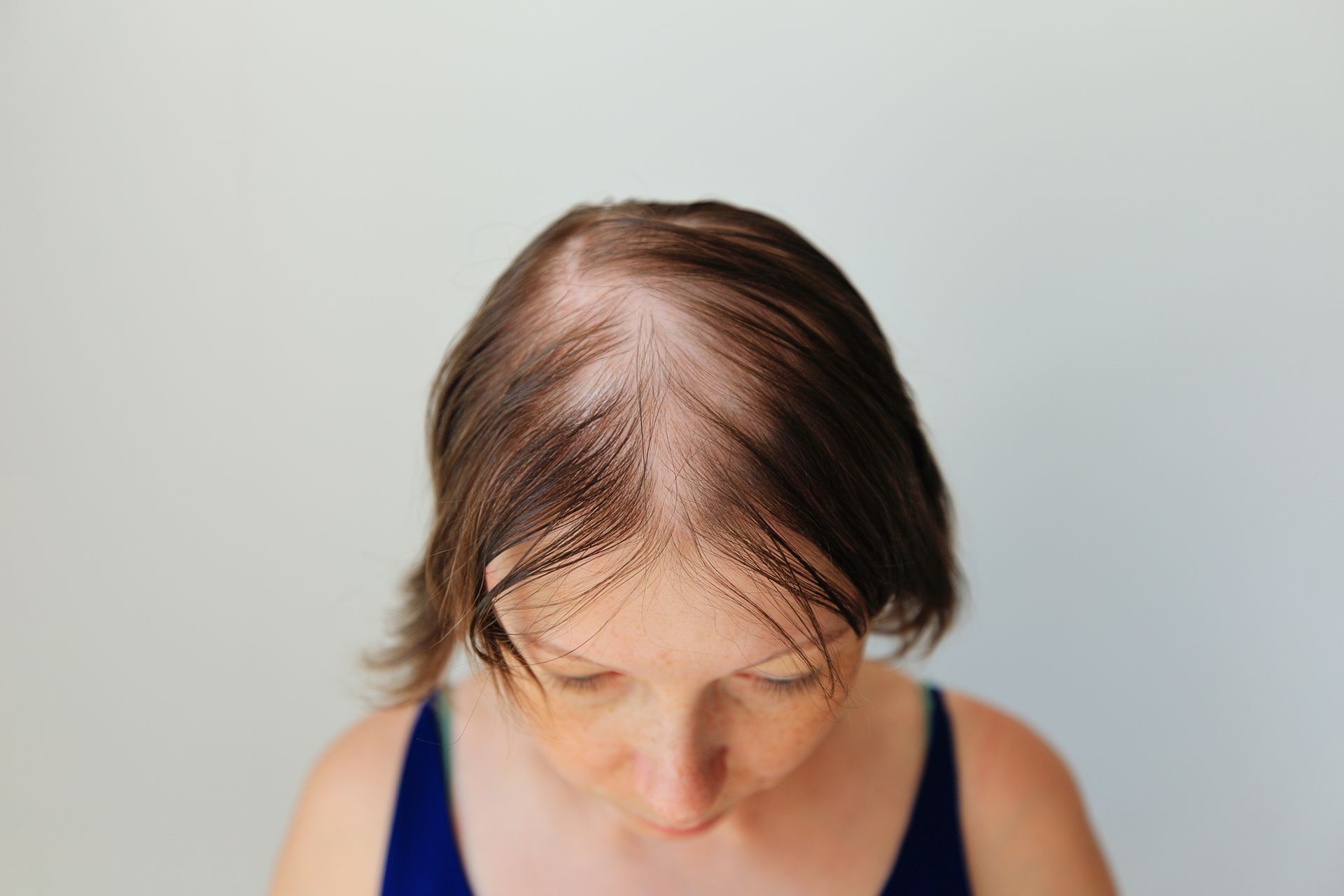 Woman with Alopecia