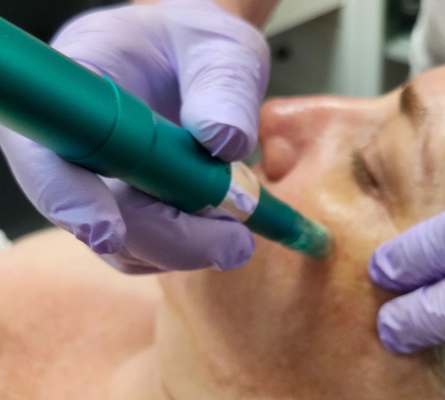 Woman Having a Micro-Needling Session