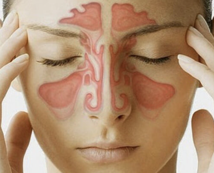 A woman is holding her head because she has a sinus infection