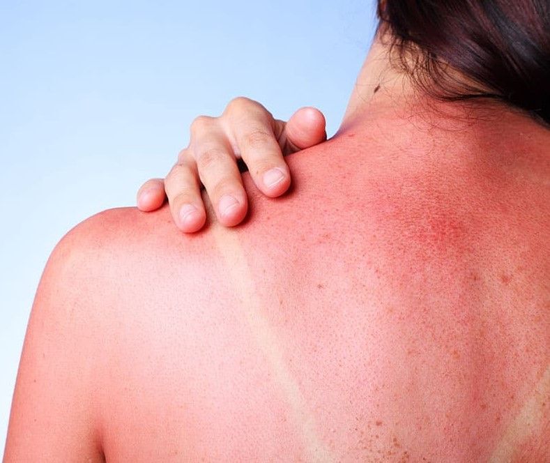 A woman is holding her hand on her sunburned back.