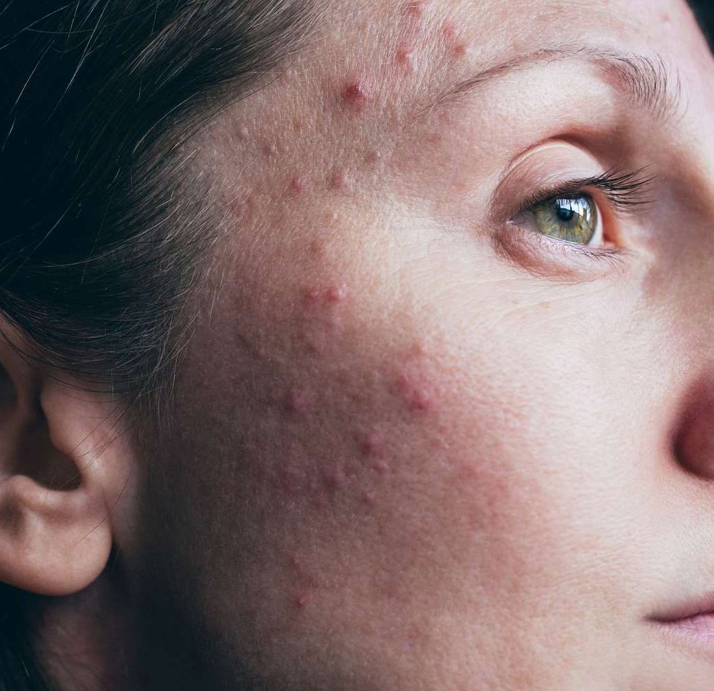 A close up of a woman 's face with acne on it.