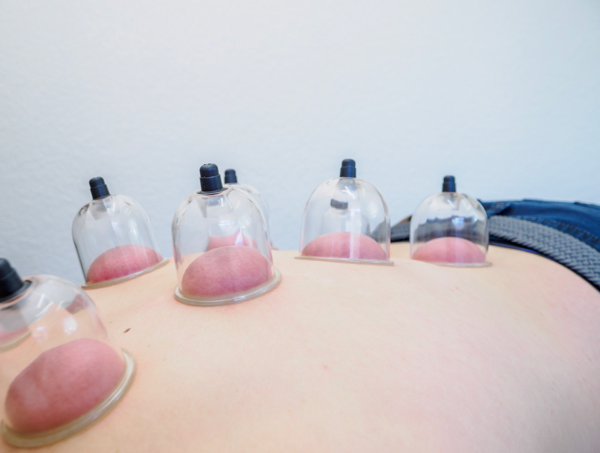 A person is getting cupping treatment on their back.