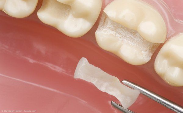 Keramik-Inlays Zahnarzt Friedrichshafen, Dr. Spänle