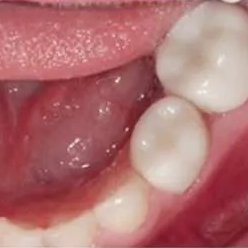 Close-up view of a person's mouth, with swollen, reddish gum tissue near the molar teeth.
