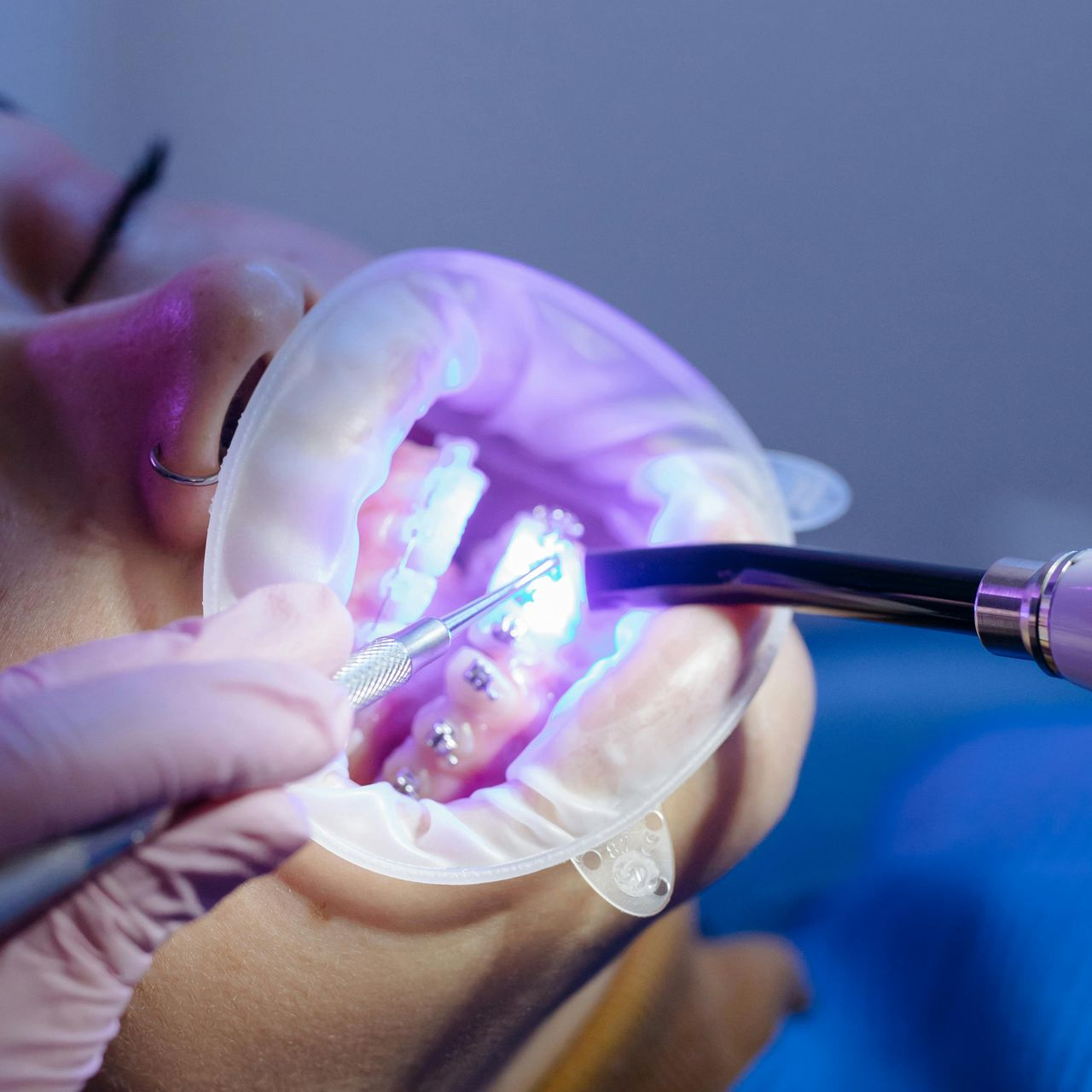 Person in dentist chair with mouth retractor; dental procedure with UV light.