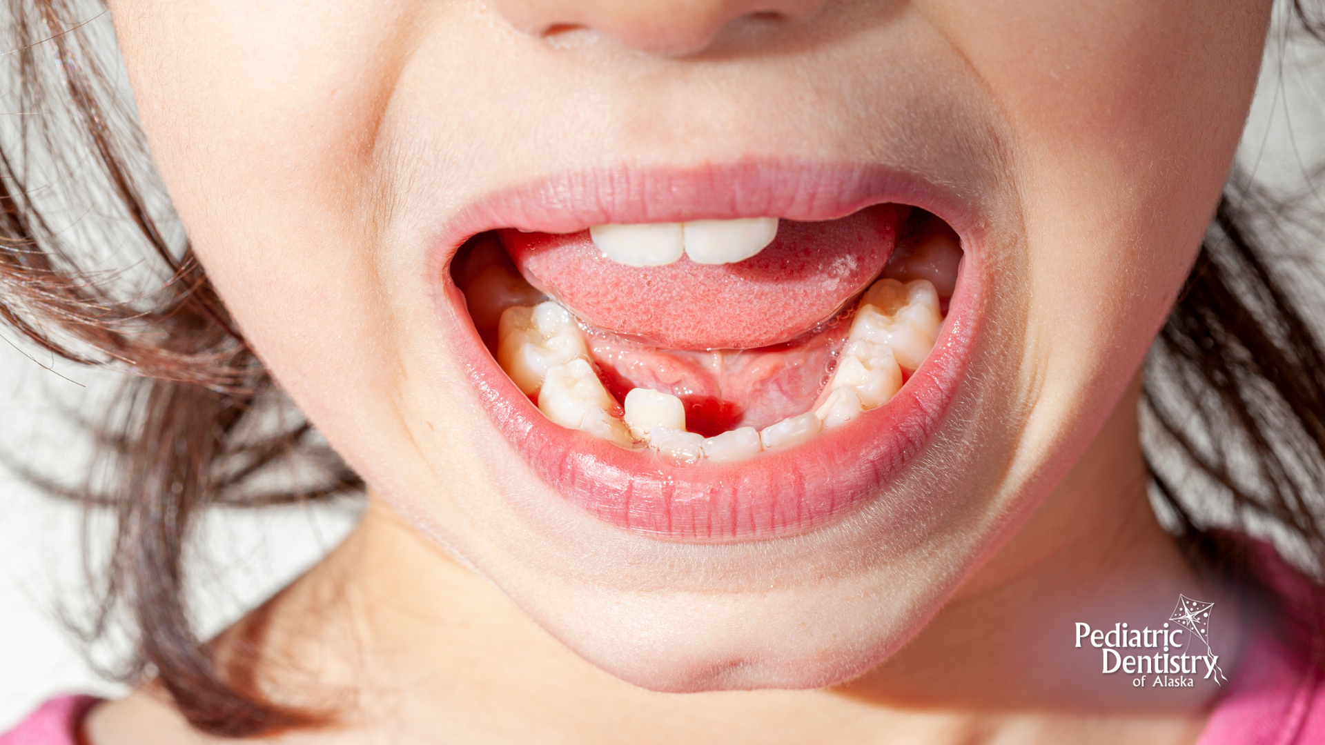 A close up of a child 's mouth with a missing tooth.