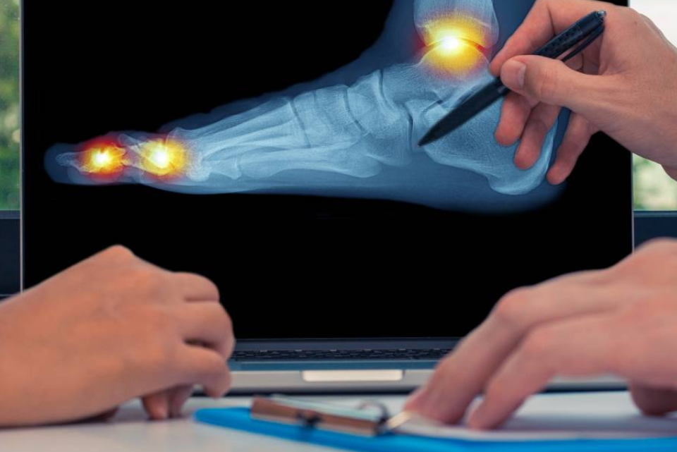 Radiografia del piede con evidenziate le zone doloranti, un medico indica lo schermo.