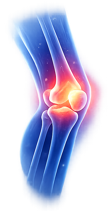 Illustrazione anatomica di un'articolazione del ginocchio; le aree evidenziate indicano il dolore.