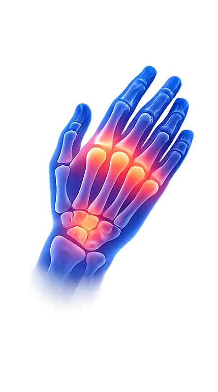 Mano con aree doloranti evidenziate, che indicano infiammazione delle articolazioni.