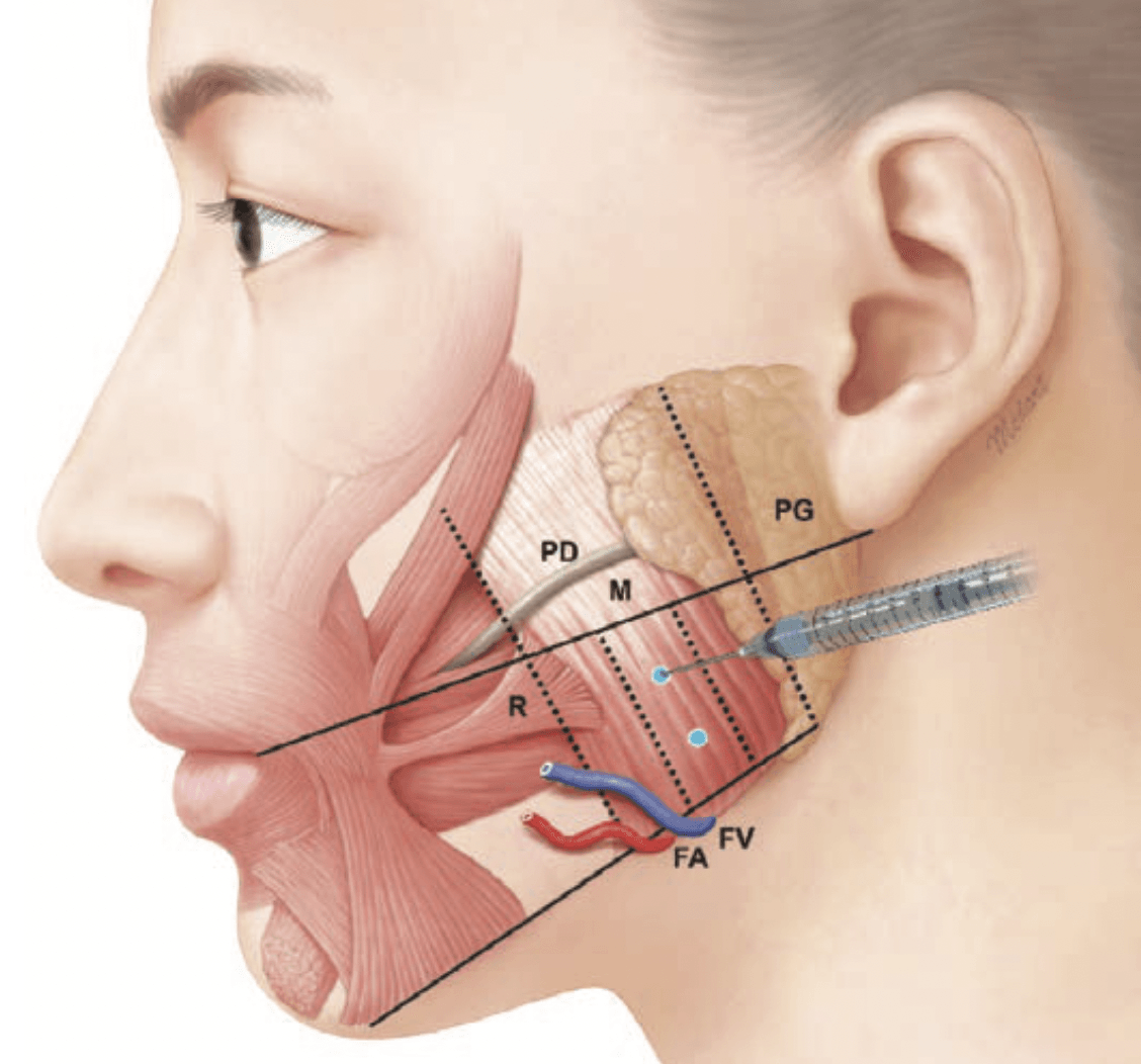 An overview of masseter injections - Cosmetic Connection