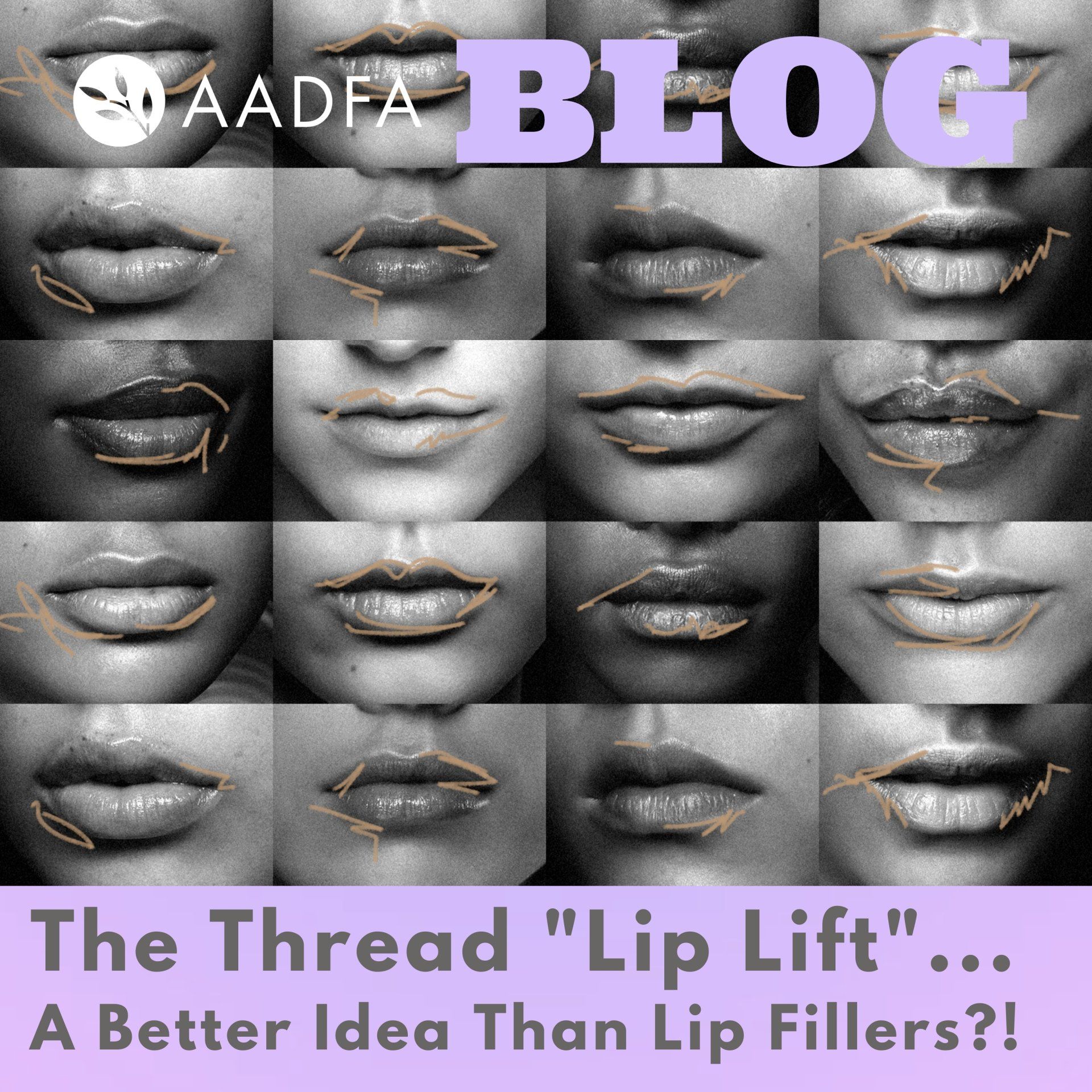 The AADFA Thread Lip Lift