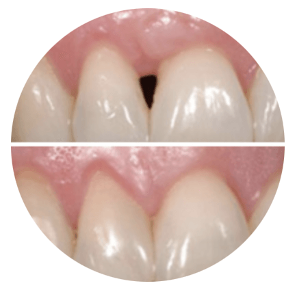 A before and after picture of a person 's teeth