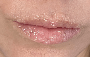 Fig.4: Exfoliation (lip scrub) to gently cleanse the lips, while enzymes promote skin renewal.