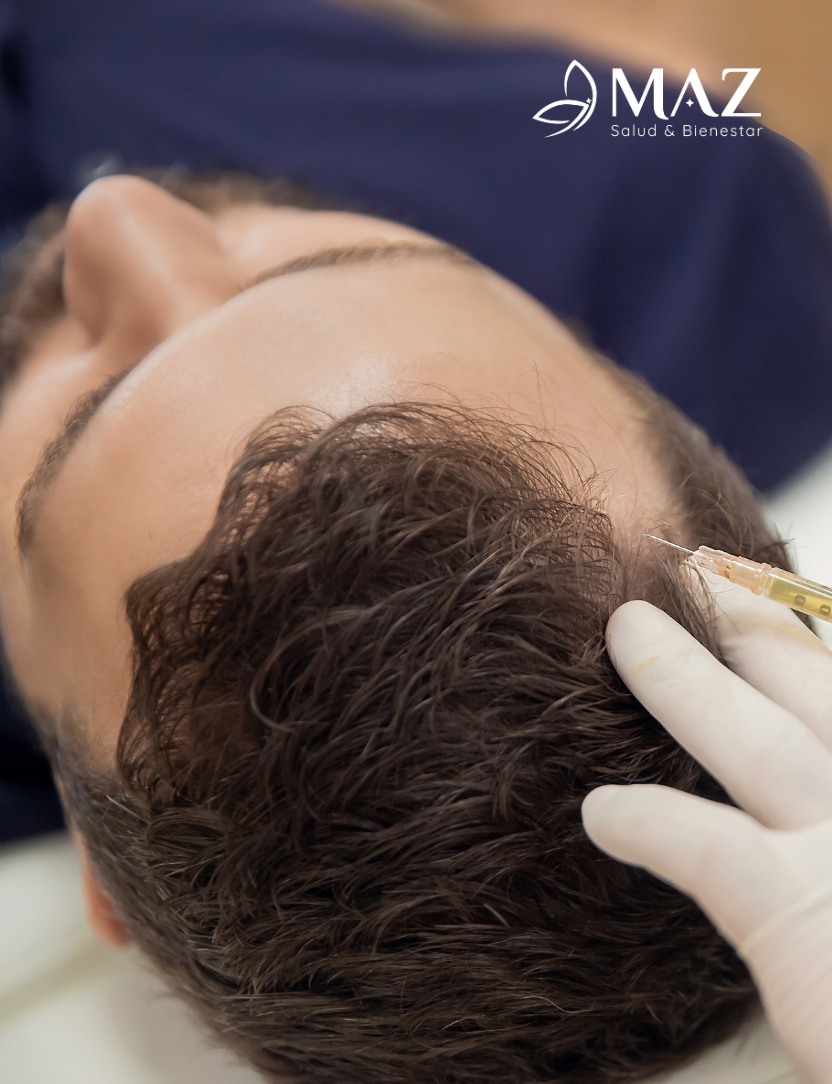 Aplicación de mesoterapia capilar para estimular el crecimiento del cabello desde la raíz.