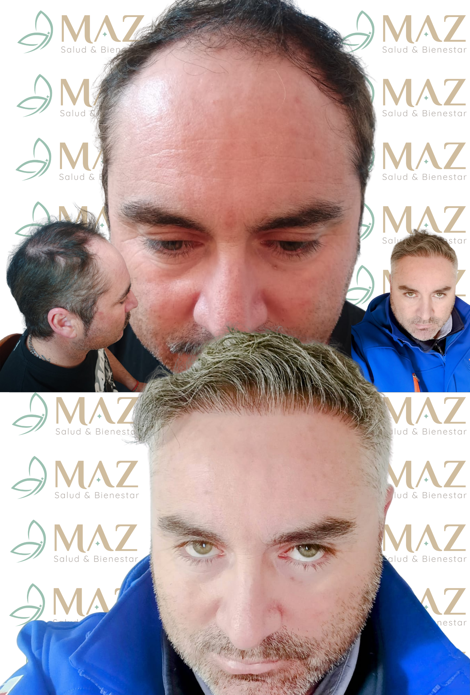 Un hombre con barba se ha sometido a un trasplante de cabello.