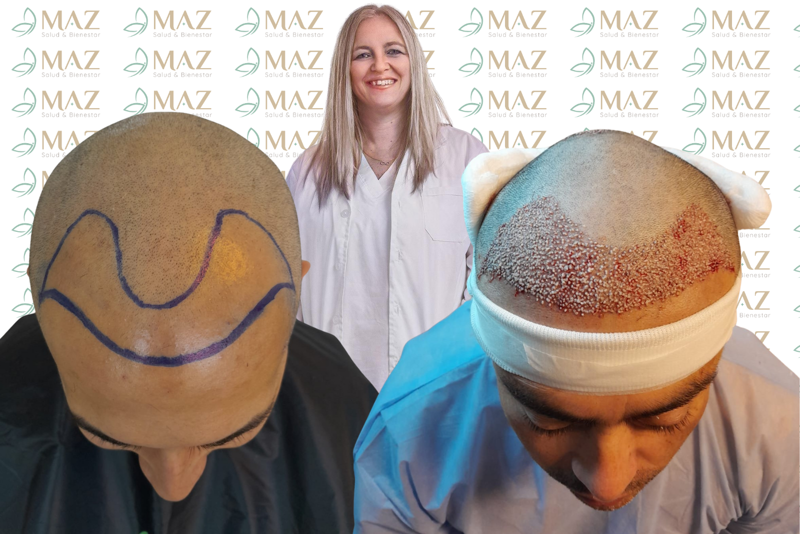 Implanate Capilar en Argentina, antes y despues inmediatode 