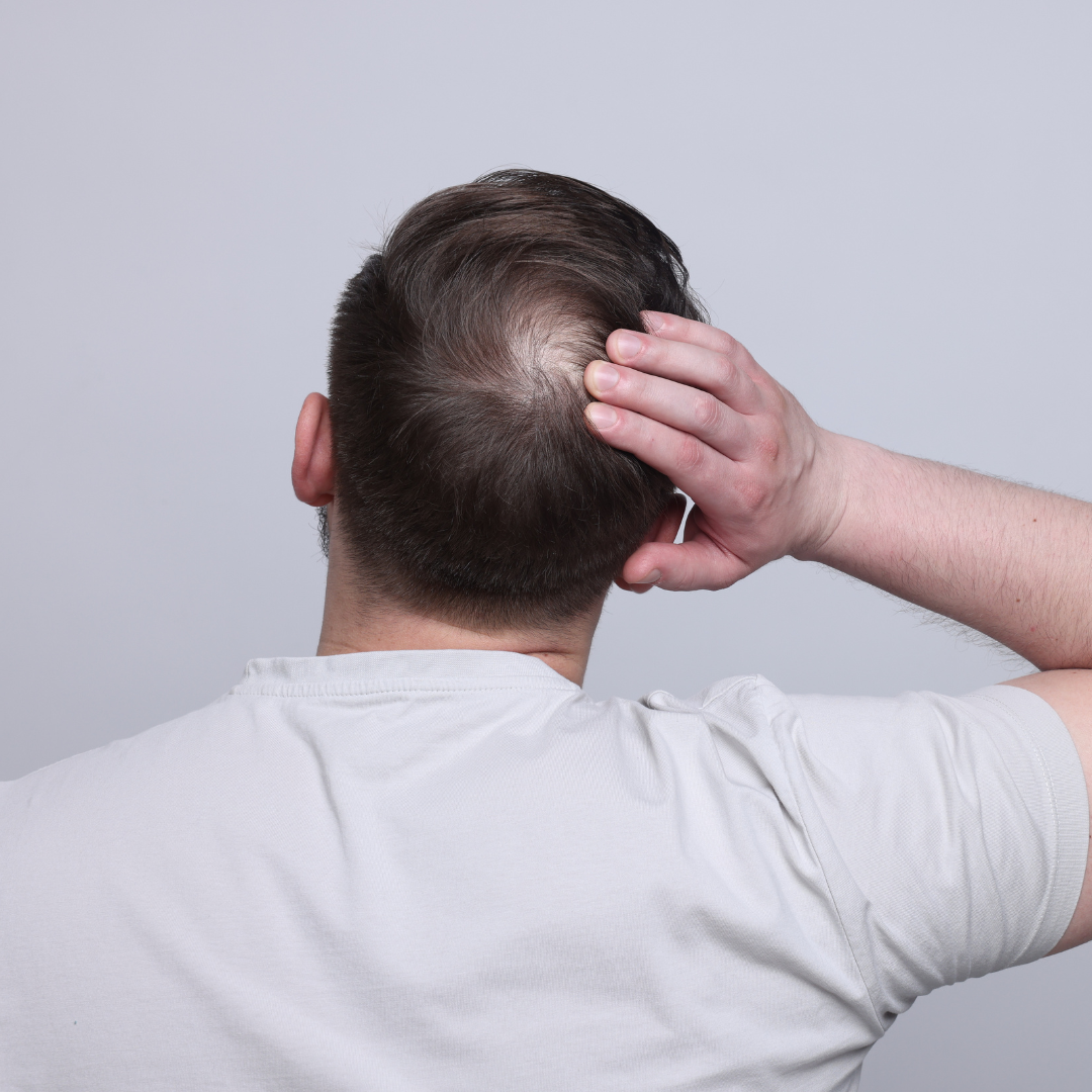 Alopecia androgenética en hombres: pérdida progresiva en zona de la coronilla.