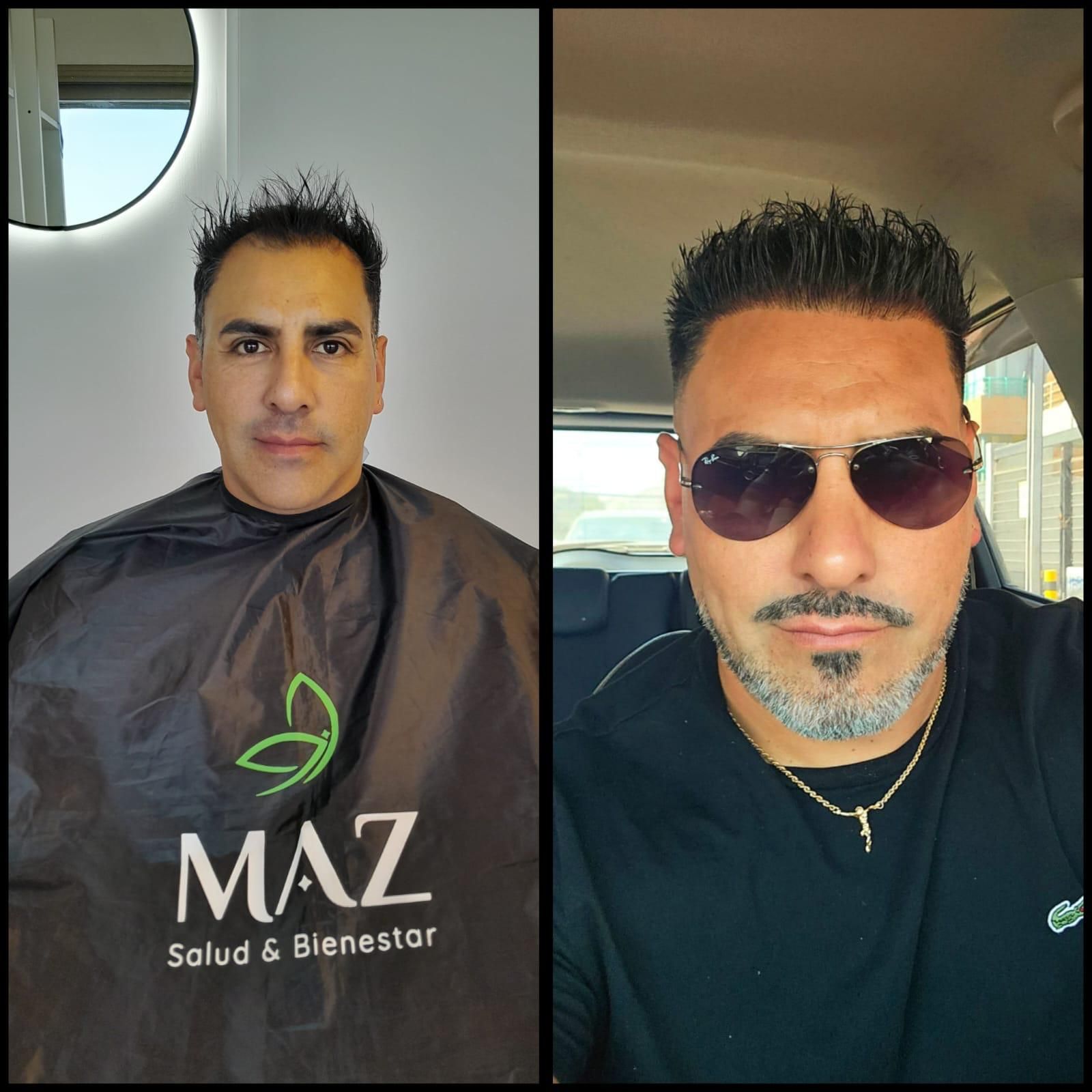 Pacientes posimplante capilar con resultados visibles en zona frontal.