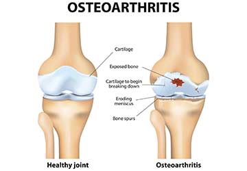 A diagram used by an arthritis doctor in Johnson City, TN