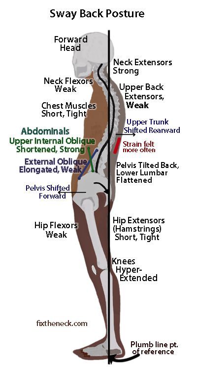 Sway Back Posture — Lexington, KY — Body Structure